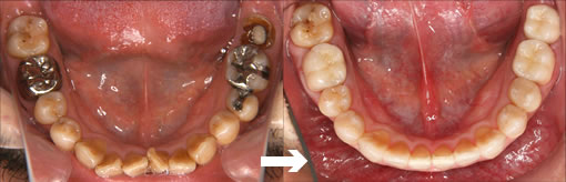歯列矯正の症例2（コルチコトミー併用矯正）写真