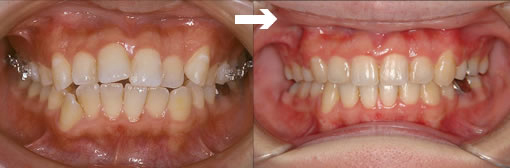 歯列矯正の症例3（インプラント矯正）写真