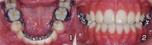 歯列矯正の症例4（舌側ぜっそく矯正）写真