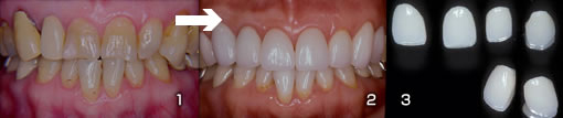 その他の審美歯科治療の症例3写真