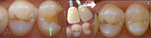 その他の審美歯科治療の症例3写真